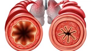 Asthma bronchiale – Anzeichen und Behandlung