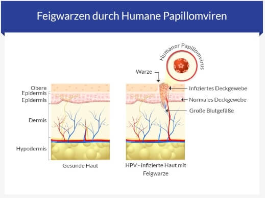 Feigwarzen-Ursachen